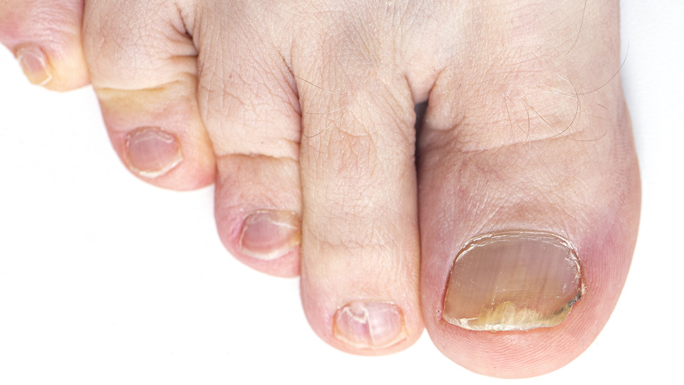 Get Rid of Yellow Toenails For Good With These 4 Natural Remedies